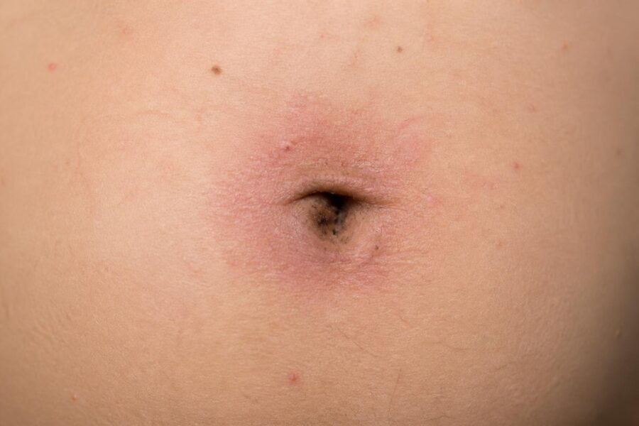 Close-up da barriga de uma pessoa mostrando o umbigo com aparência irritada e pouco limpa.