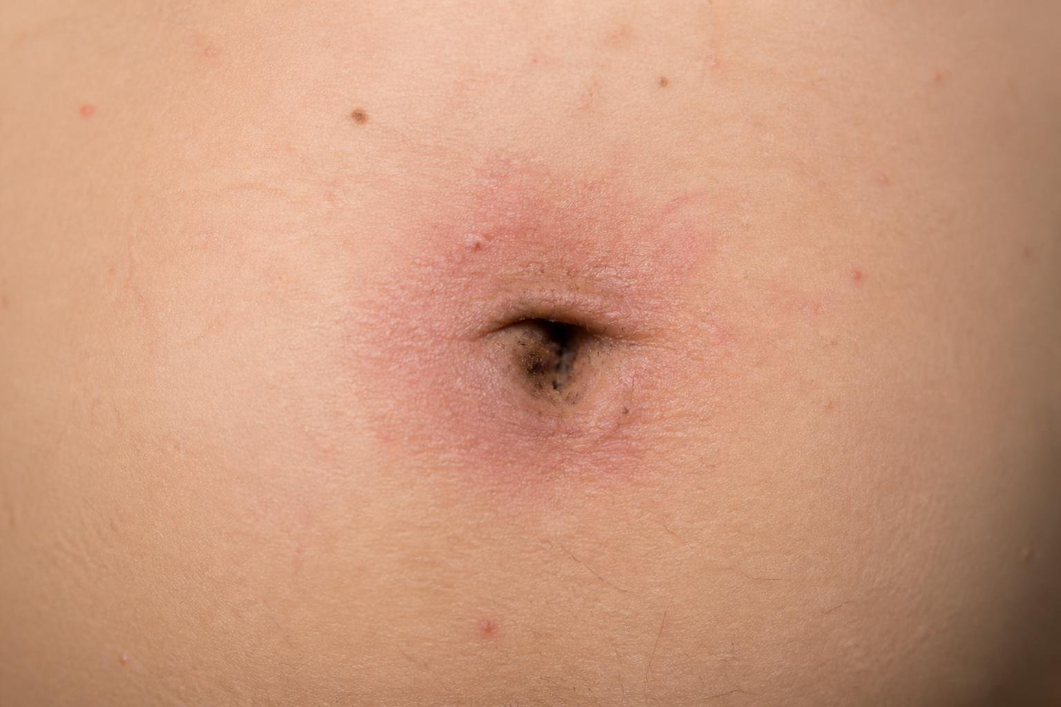 Close-up da barriga de uma pessoa mostrando o umbigo com aparência irritada e pouco limpa.